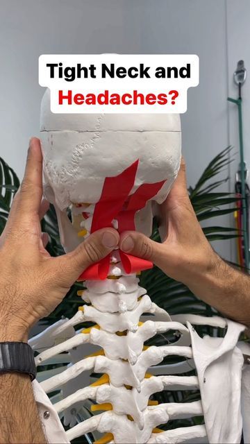 Dr. Joe Damiani - TMJ, Head & Neck Specialist on Instagram: "Do you experience persistent headaches and you also feel tension in the back of the neck and base of the skull? Well, you may be experiencing tightness from the neck which is compressing the nerves at the base of the skull producing suboccipital neuralgia, which is compression of the greater occipital nerve. These types of headaches can be persistent in the back of the head or the side of the head all the way to the eye. This is a great way to release those muscles and free up the space in the base of the skull to reduce headaches. #tensionheadache #headacherelief #migrainelife #cervicogenicheadache #tmjtreatment #tmjdisorder" Tmj Headache, Neck Headache, Reduce Headaches, Spine Problems, Occipital Neuralgia, Neck Problems, Headache Types, Neck Exercises, Spine Health