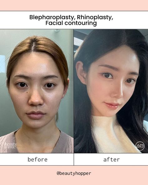 #plasticsurgery #plasticsurgerygonewrong #beforeafter #celebritiesbeforeafter #hollywoodstars #bignosesurgery #surgery #facesurgery #vlinesurgery #koreanplasticsurgery #kpopplasticsurgery #nosejob #jawreductionsurgery #eyesurgery #cheekfillers #rhinoplasty #facelift #plasticsurgeryfails #expensiveplasticsurgery #viral Korean Plastic Surgery Before And After, Korean Surgery, Kpop Plastic Surgery, Jaw Reduction Surgery, Change Appearance, V Line Surgery, Plastic Surgery Korea, Plastic Surgery Fail, Korean Plastic Surgery