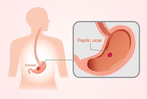 There are many people who don't know that stomach ulcers can be dangerous. If you are the one, read the following blog for more information. Home Remedy For Ulcers Stomach, Abdominal Discomfort, Gastrointestinal Disorders, Chronic Obstructive Pulmonary Disease, Stomach Ulcers, Reflux Disease, Pulmonary Disease, Stomach Pain, Abdominal Pain