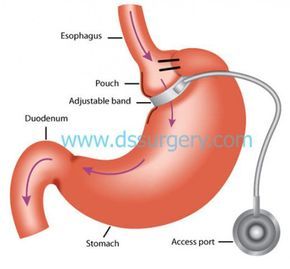 I am a lapband patient and feel these questions and answers about the lap band will be helpful for those wanting to have weight loss surgery. I have been successful but the struggles have been great. It is not a magic wand and it requires work but it will help save your life if it needs saving. Lapband Surgery Before And After, Lap Band, Gastric Band, Shoulder Pain, Questions And Answers, Health Blog, Question And Answer, Transformation Body, Losing Weight