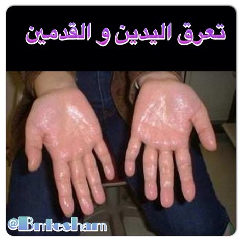 http://instagram.com/p/fTkZP8C4Nd/ Sweating Remedies, Hand Sweating, Sweaty Palms, Stop Sweating, Sweaty Hands, Excessive Sweating, Natural Home Remedies, Natural Treatments, Home Health