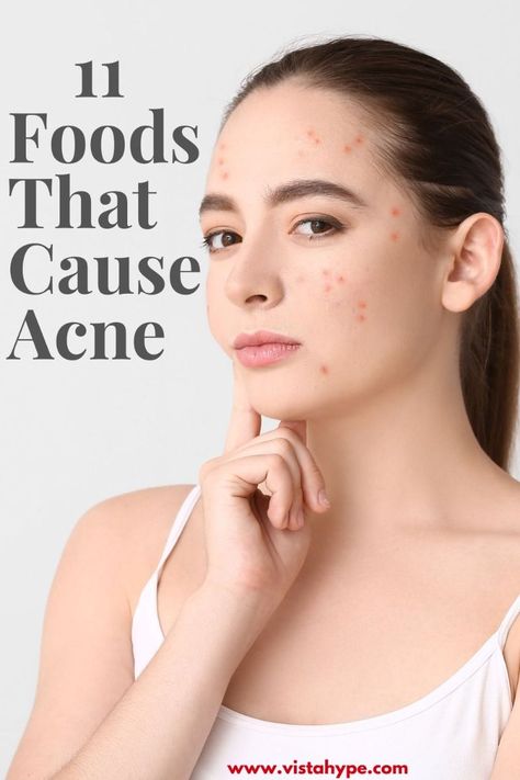 #Acne #SkinCare #Diet 

Are you eating foods that are causing your acne and bad skin? Find out the 11 worst offenders and how to avoid Foods That Cause Acne, Anti Acne Diet, Skincare Diet, Acne Causing Foods, Chin Acne, Cystic Acne Remedies, Acne Clearing, Bad Skin, Forehead Acne