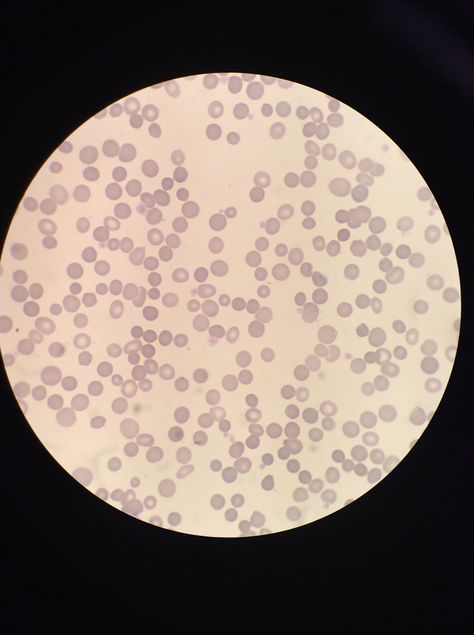 hereditary spherocytosis spherocyte 3+ Hereditary Spherocytosis, Square, Tableware, Quick Saves