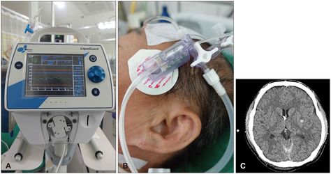 Intra Cranial Pressure (ICP) Monitoring Devices Market Subarachnoid Hemorrhage, Intracranial Pressure, Critical Care Nursing, Trend Analysis, Swot Analysis, Critical Care, Research Report, Market Research, Sales And Marketing