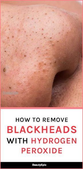 Remove Blackheads From Nose, How To Remove Blackheads, Blackhead Remover Diy, Black Head Remover Mask, To Remove Blackheads, Blackheads Removal, Cold Sores Remedies, Remove Blackheads, Sleep Remedies