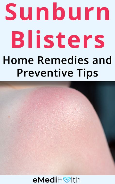 Sun Blisters, Sunburn Blisters, Blister Remedies, How To Heal Blisters, Home Remedies For Sunburn, Heal Sunburn, Medicine Kit, Sunburn Remedies, Sun Lotion