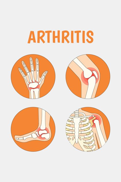 Learn about how different types and causes of arthritis affect joints in different ways, along with how to get relief from arthritis pain. Nerve Pain Remedies, Calf Cramps, Nerve Health, Sagittarius Quotes, Nerve Pain Relief, Sciatic Nerve Pain, Health Talk, Sciatic Nerve, Joints Pain Relief