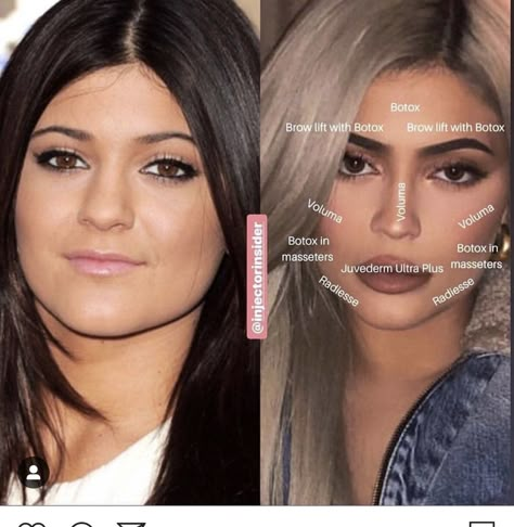 Kylie Jenner Plastic Surgery, Botox Brow Lift, Cosmetic Fillers, Face Fillers, Cheek Fillers, Beauty Procedures, Facial Contouring, Facial Fillers, Cosmetic Injectables