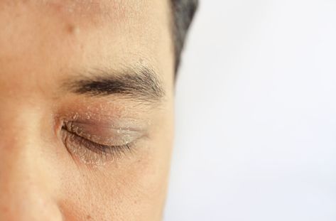 Why Do I Have Dry Skin on My Eyelid? Dry Skin Around Eyes, Dry Eyelids, Irritated Eye, Laser Surgery, Dry Skin Remedies, Upper Eyelid, Eye Surgery, Eyeglass Lenses, Peeling Skin