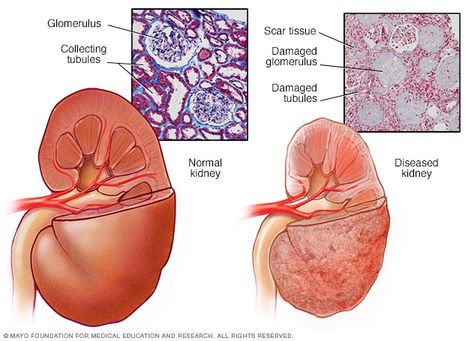 End-stage renal disease - Symptoms and causes - Mayo Clinic Acidic Vs Alkaline Foods, Human Digestive System, Human Body Organs, Kidney Damage, Kidney Function, Chronic Kidney, Disease Symptoms, Medical Anatomy, Fast Facts