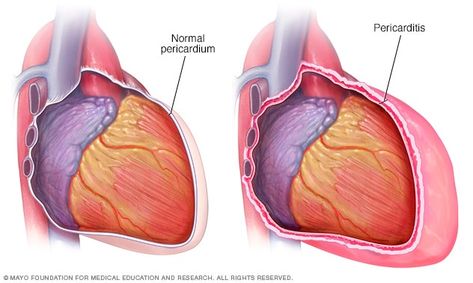 Pericardial Effusion, Pleural Effusion, Heart Muscle, Heart Conditions, Lung Disease, Heart Surgery, Shortness Of Breath, Mayo Clinic, Chest Pain