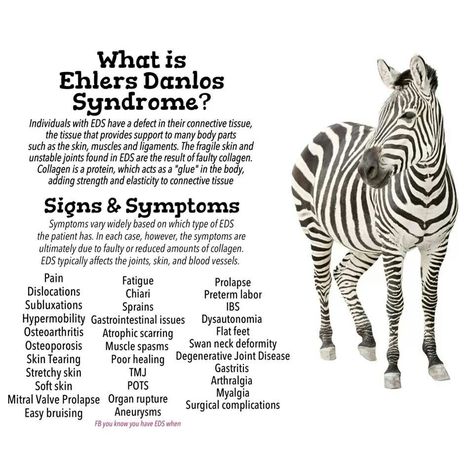 #EhlersDanlosSyndrome Awareness #EDS ~There are at least 6 varieties of Ehlers Danlos and not everyone has every symptom. Vascular Ehlers Danlos Syndrome, Ehlers Danlos Syndrome Types, Ehlers Danlos Syndrome Symptoms, Elhers Danlos Syndrome, Ehlers Danlos Syndrome Hypermobility, Ehlers Danlos Syndrome Awareness, Party Tricks, Rare Disorders, Chiari Malformation