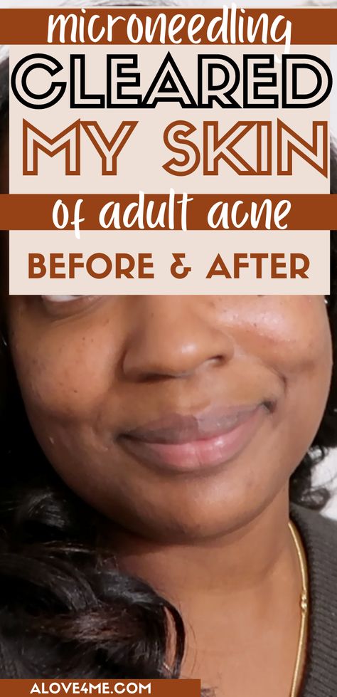 Sharing how my derm cleared my acne-prone skin of scars and dark marks with microneedling Microneedling Before And After Black Skin, Microneedling After Care, Microneedling Before And After, Microneedling Benefits, Home Microneedling, Benefits Of Microneedling, Best Stretch Mark Removal, Before And After Acne, Acne Prone Skin Care Routine