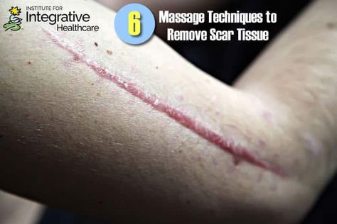 Six Massage Techniques to Remove Scar Tissue Deep Tissue Techniques, How To Get Rid Of Scar Tissue, Scar Tissue Massage, Surgery Prep, Scar Massage, Surgery Aesthetic, Knee Rehab, Fascia Blasting, Mastectomy Scars