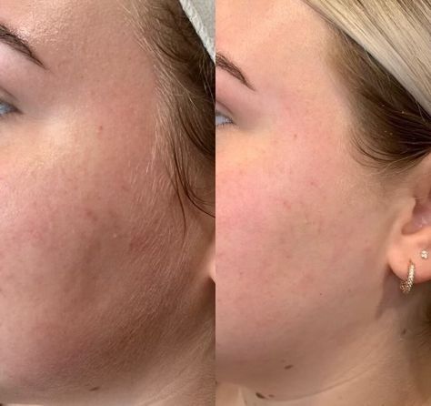 🌻DERMAPLANING? - exfoliation and removal of the very top layer of the skin done by use of a medical grade scalpel. 🌻BENEFITS? • Rejuvenated Skin • Fewer Fine Lines and Wrinkles • No More Peach Fuzz • Smoother Cosmetic Application • Cleaner Smaller Pores • Help with Acne #dermaplaning #beautifulskin #gorgeousskin #skincare #imageskincare #cleanskin #style #trending #beauty #makeup #marketstreet #newburystreet #readingma #stoneham #fashionweek #boston #massachusetts Dermaplaning Before And After, Newbury Street, Smaller Pores, Scalpel, Gorgeous Skin, Best Salon, Image Skincare, Wrinkled Skin, Peach Fuzz