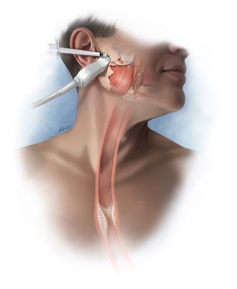 Salivary Glands, Botulinum Toxin, Salivary Gland, Medical Illustration, Blood Cells, Surgery, Medical, Medical Illustrations