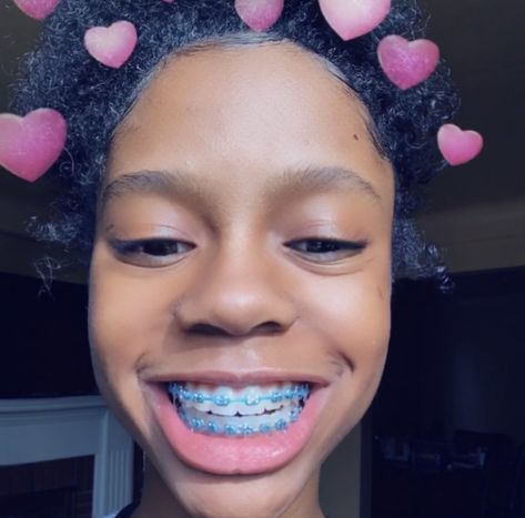 youknow I always come through withh some lit pinns ... follow me @lovejne01 for more ❤️ ... if you have any ideas on boards just message me ! & please give me my CREDIT all I ask LOVEYOUU Light Blue Braces, Girl With Braces, Dental Braces Colors, Braces Colors Combinations, Invisible Teeth Braces, Blue Braces, Braces Retainer, Braces Colors Ideas