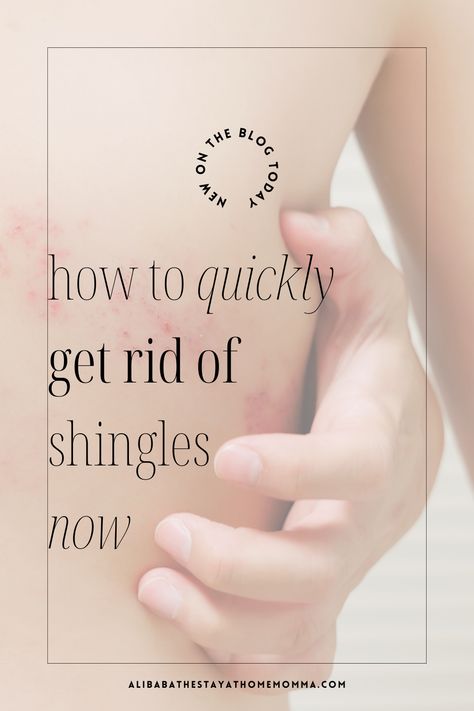 Shingles are the worst and as a mom we need to recover quickly. I was 34 when I got shingles for the first time. I consider myself healthy and take care of my stress, but my immunity could not keep up with a newborn and moving homes. 

However, I was able to quickly get rid of shingles and I'd like to share for anyone looking for quick shingle remedies. 

Follow the link to read how I cleared shingles within a week. What Causes Shingles, Shingles Pain Relief, Shingles Remedies, Shingles Relief, Shingles Rash, Scalp Itch, Calamine Lotion, Best Lotion, Detox Bath