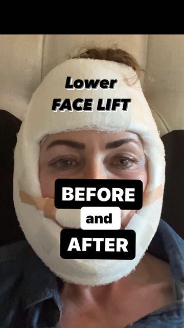 Liquid Facelift Before After, Chin Lift Before And After, Face Lift Before And After, Lip Lift Before And After, Plastic Surgery Before And After, Face Lift Tape Before And After, Neck Lipo Before And After, Neck Lift Before And After, Face Tape Lift