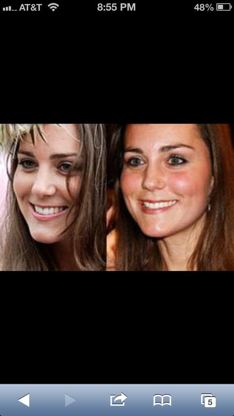 Nose job??? Maybe? Meghan Markle Nose Job, Meghan Markle Plastic Surgery, Nose Jobs, Surgery Doctor, Plastic Surgery Procedures, Facial Plastic Surgery, Celebrity Plastic Surgery, Dental Veneers, Celebrities Before And After