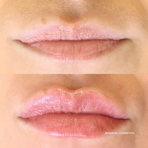 0.55ml Lip Filler, Lip Filler Inspiration Heart Shaped, .5ml Lip Filler, 5 Ml Lip Filler, Lip Filler Small Mouth, Small Lip Fillers Before And After, Lip Filler Inspo 0.5ml, Lip Filler Inspiration 0.5ml, Lip Filler Before And After Small Lips