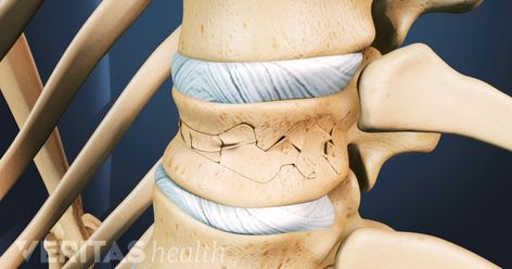 A bone density test (also termed "bone mineral density test" or "BMD test") is the gold standard diagnostic procedure used to detect osteoporosis. Bone Density Test, Spine Health, X Rays, Medical Terms, Bone Density, Standardized Testing, Medical History, Body Health, The Gold