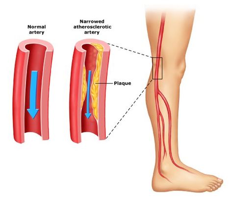 In our many years of practicing medicine, we’ve found that there are two medical terms that almost always confuse our patients. The two terms are peripheral artery disease (PAD) and peripheral vascular disease (PVD). We do understand the confusion. These two terms sound similar, as if they’re describing the same disease or medical condition. It’s […] Vascular Surgery, Arteries And Veins, Face Cream Best, Leg Pain, Medical Terms, Skin Disorders, Sciatica, Blood Vessels, Best Face Products