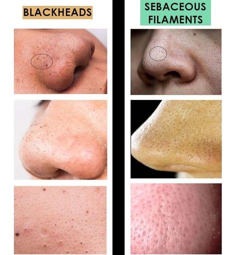 Blissful skin, Esthetician, waxing, brow lamination and tinting on Instagram: "A sebaceous filament is NOT a blackhead. Blackheads are temporary isolated pore blockages (like a pimple). Sebaceous filaments are a widespread, recurring natural feature of your skin, which you can’t completely get rid of. But with proper management you can make them smaller, less irritated and even invisible to the human eye. *************************************** #facials #skincare #beauty #esthetician #waxing Skin Esthetician, Beauty Esthetician, Sebaceous Filaments, Compton California, Back Facial, The Human Eye, Get Rid Of Blackheads, Brow Lamination, Oil Cleanser