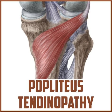 Popliteus Tendinopathy: A Poorly Understood Cause of Knee Pain - Sports Medicine Review Avulsion Fracture, Knee Care, Knee Strengthening Exercises, How To Strengthen Knees, Therapeutic Activities, Knee Exercises, Knee Replacement, Health And Fitness Articles, Strengthening Exercises