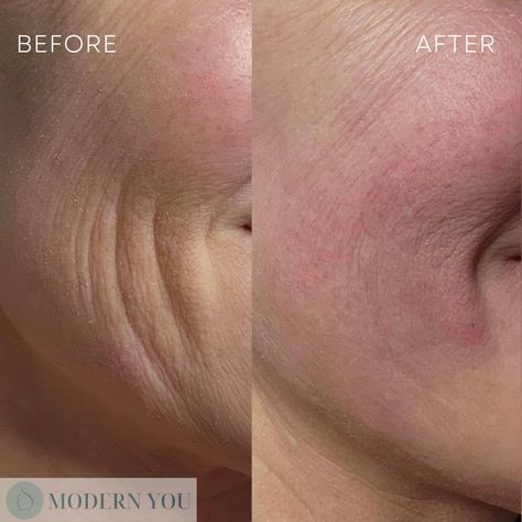 Skin booster before and after, wrinkles before and after, smile lines before and after, skin booster results Aesthetic Nurse Injector, Nurse Injector, Aesthetic Nurse, Skin Aesthetic, Skin Booster, Smile Lines, Textures And Tones, Dermal Fillers, Collagen Production