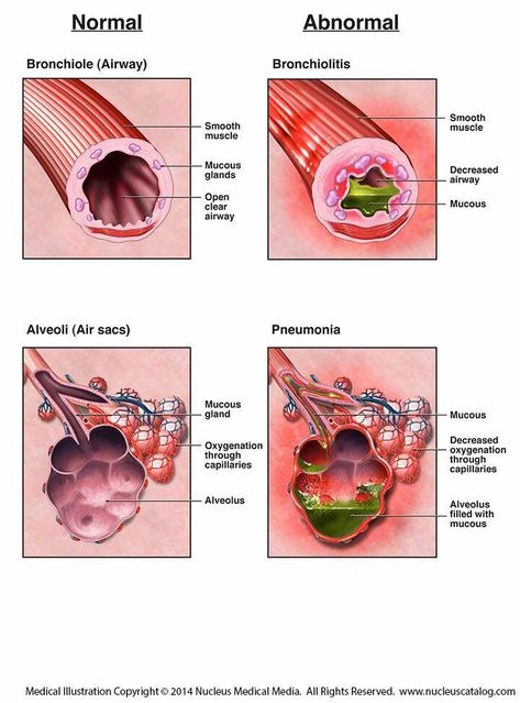 Normal Bronchioles & Alveoli VS. pneumonia & bronchiolitis infections of Bronchioles & Alveoli. Lung Anatomy, Student Info, Nurse Study Notes, Family Nurse Practitioner, Pulmonology, Respiratory Therapy, Nursing School Notes, Human Anatomy And Physiology, Medical Anatomy