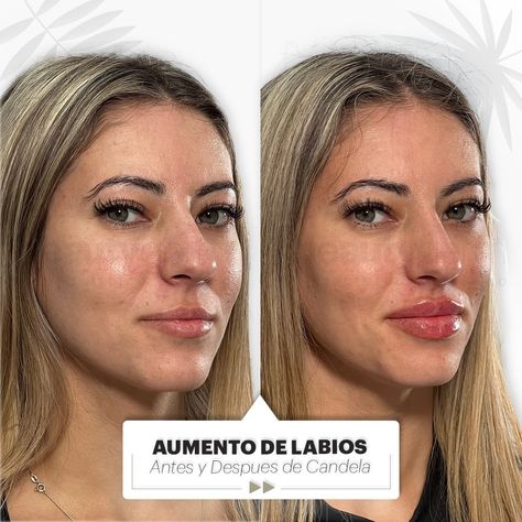 Ella es nuestra paciente Candela y queremos compartirte su antes y después 😁 Le realizamos un aumento de labios para alcanzar el grosor deseado 👄 En Beautyderm siempre buscamos resultados naturales que destaquen la belleza de cada paciente✨ ¿Qué te parece este antes y después? ⏩ Te leemos en comentarios. 📍Pedí un turno para comenzar 📱 11 5494 3993 #aumentodelabios #rellenodelabios #rostroiluminado #volumenenlabios #hidrataciondelabios #medicinaestetica #esteticaargentina April 26, On Instagram, Instagram