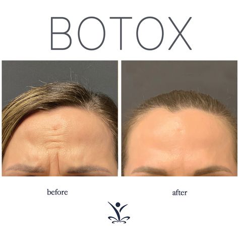 Everybody loves their Botox®! It’s one of the most commonly performed aesthetic treatments. While Botox is extremely safe, there are risks which is why it’s important for patients to do their research to find an experienced provider. Even after 9 years in business with a team of experienced injectors, we continue to train and stay on top of the latest advancements in aesthetics. It’s earned us the top 1% spot in the country with the amount of Botox & filler that we perform each year. Botox Forehead, Aesthetic Treatments, Botox Before And After, Botox Filler, Botox Lips, Botox Fillers, Botox Injections, A Team, Lips