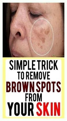 Age Spot Removal, Brown Spots On Skin, Spots On Skin, Dark Spots On Face, Brown Spots Removal, Brown Spots On Face, Dark Spots On Skin, Skin Spots, Baking Soda Shampoo