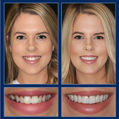 Teeth After Braces, Teeth Makeover, Cosmetic Dentistry Procedures, Veneers Teeth, Discolored Teeth, Sedation Dentistry, Aesthetic Dentistry, Beautiful Teeth, Teeth Shape