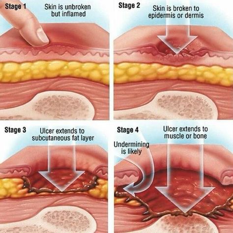 Pressure ulcer staging Pressure Ulcer Staging, Geriatric Nursing, Wound Care Nursing, Nursing Information, Nursing Assessment, Bed Sores, Pressure Ulcer, Nursing Mnemonics, Nursing School Survival