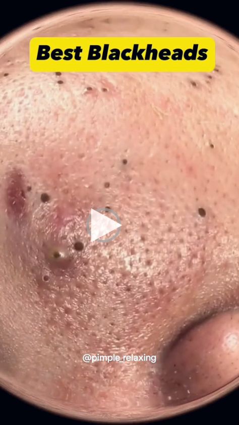 ▷pimples popping video blackhead removal homecoming makeup black women, homecoming makeup pink, homecoming makeup looks for brown eyes, homecoming makeup tutorial,