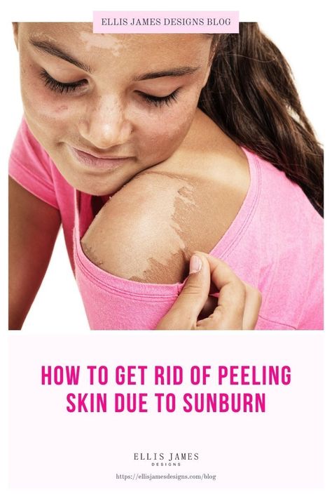 If you are struggling with your skin peeling, make sure to look at the reasons and recommendations in this post. | How to Stop Peeling Skin: Ways to Stop Peeling Once It Starts | Peeling Skin: Natural Ways to Get Rid of Peeling Skin Fast | How to get rid of peeling skin immediately | Why Does My Skin Peel? How to Get Rid of Skin Peeling | How to Exfoliate Peeling Skin | Should you exfoliate peeling skin? | #founditonamazon #skinpeeling #skincaretips #beautytips #skintips Sunburn On Face, Look Less Tired, Face Peeling, Flaking Skin, Face Peel, Skin Peel, Health Guru, Healthy Lifestyle Habits, Get Rid Of Blackheads