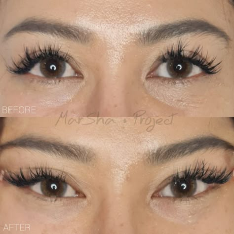 Fox Eye Lift Surgery, Pdo Threads Under Eyes, Cat Eye Surgery Before And After, Cat Eye Surgery, Fox Eye Surgery Before And After, Fox Eye Thread Lift, Fox Eye Surgery, Fox Eye Lift, Eyes Surgery