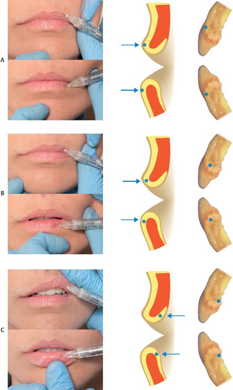 Lip Filler Mapping, Dermal Fillers Lips, Beer For Hair, Face Fillers, Aesthetic Dermatology, Dental Photography, Botox Cosmetic, Facial Fillers, Cosmetic Injectables