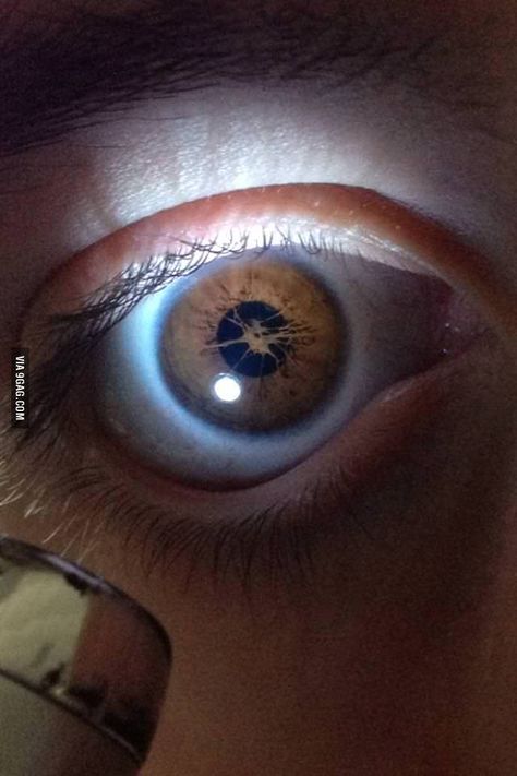 My friend's eye. I can't remember what he said causes it to be like this Broken Iris Eye, Eye Looking Up, Eyes Looking Up, Faded Eyes, Broken Iris, Lifeless Eyes, Dead Eyes, Rare Eye Colors, Iris Eye