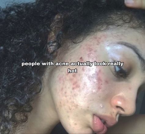 Girl With Acne, People With Acne, Bad Acne, Bare Beauty, Pretty Skin, You're Beautiful, I Feel Good, Just Girly Things, Up Girl