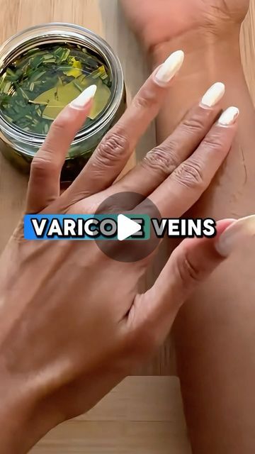 Varicose Vein Remedy Natural Treatments, Knee Inflammation Remedies, Fluid Retention Remedies, Spider Vein Remedies, Leg Circulation Remedies, Apothecary Remedies, Inflammation Remedies, Vein Health, Knee Pain Remedy