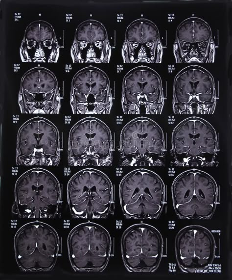 MRI scan image of brain. For diagnosis #Sponsored , #PAID, #ad, #scan, #brain, #image, #MRI Mri Brain Scan Image, Mri Brain Scan, Mri Scan Aesthetic, Brain Mri Scan, Neuroscience Aesthetic, Brain Mri, Brain Imaging, Med Doctor, Brain Scans