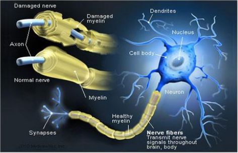 Chronic Inflammatory Demyelinating Polyneuropathy (CIDP) - Physiopedia Human Body Nervous System, Chronic Inflammatory Demyelinating Polyneuropathy, Multiple Sclerosis Symptoms, Ms Symptoms, Medical Pictures, Nerve Fiber, Ms Awareness, Multiple Sclerosis Awareness, Endocannabinoid System