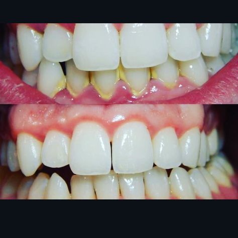 Tartar or hardened dental plaque will lead to calculus which compromises the health of your gums. Happy patient with no yellow rings around her teeth #gotothedentist #brushandfloss #getcleanings #hygienist #dentaloffice #dentistinencinitas Plaque Teeth, Dental Plaque, Plaque Removal, Best Teeth Whitening, How To Prevent Cavities, Oil Pulling, Receding Gums, Gum Health, Tooth Decay