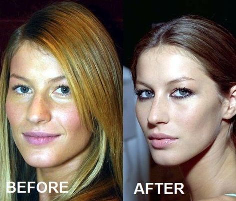 WTF plastic surgery (OUTED — Gisele Bündchen's Supermodel Secret) Nose Jobs, Plastic Surgery Photos, Plastic Surgery Gone Wrong, Nobody's Perfect, Veneers Teeth, Celebrity Plastic Surgery, Fake People, Lip Injections, Nose Job