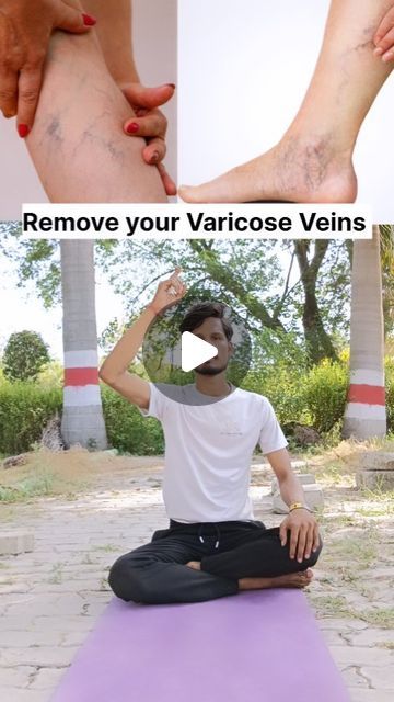 Vericous Veins Exercises, Vericous Veins, Varicose Veins Exercises, Varicose Vein Removal, Varicose Vein Remedy, Dry Brushing Skin, Leg Veins, Vein Removal, Qigong Exercises