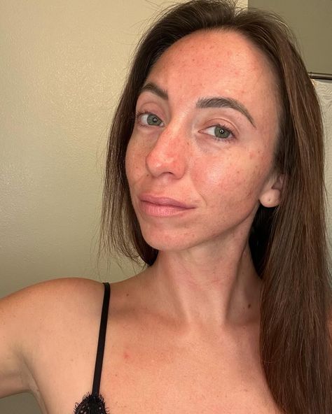 Absolutely bare faced here. No makeup, no filter, no nothing. Just me. I am 31 years old and I have some scars and acne on my face as well as crows feet. And I’m honestly proud of how I look. I am proud because I’m not perfect and I don’t want to be perfect. I want to just be me. Flaws and all. I am learning how to love myself for who I am and how I look. I’m okay with not having flawless skin. I’m okay with not looking perfect. God made me like this and God never makes mistakes ❤️ #selflove ... Makeup No Filter, 31 Years Old, I Am Learning, God Made Me, Plank Challenge, Love Myself, Flaws And All, How To Love, No Makeup