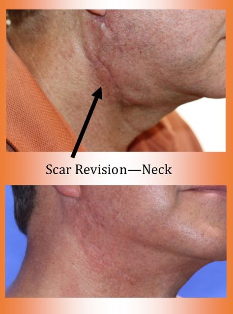 Scar Revision #plasticsurgery #scarepair #houstonplasticsurgery #beautifulresult #luxeplasticsurgery #scarrevision Scar Revision, Sugar Land, Plastic Surgeon, Plastic Surgery, Surgery, Contact Us, Repair, Makeup, Make Up